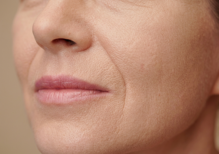Seberapa Berbeda Efek Thread Lift Lipatan Nasolabial? Penjelasan Perubahan Lifting Midface yang Kendur 사진 8