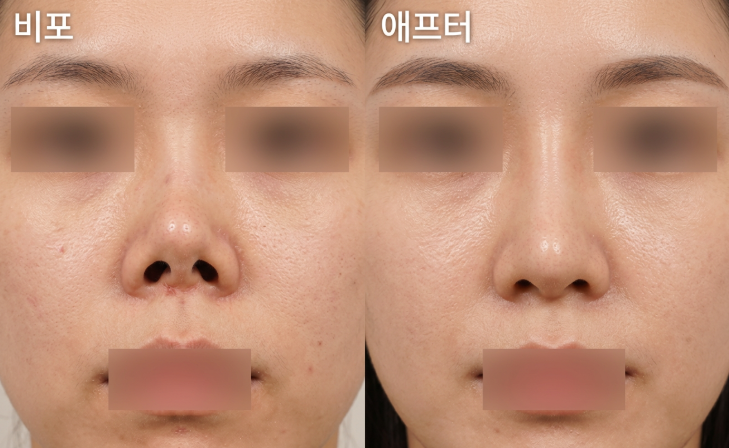Is Short Nose Revision Surgery Due to Contracted Nose Appearing as a Snub Nose? Cases Requiring Revision Surgery