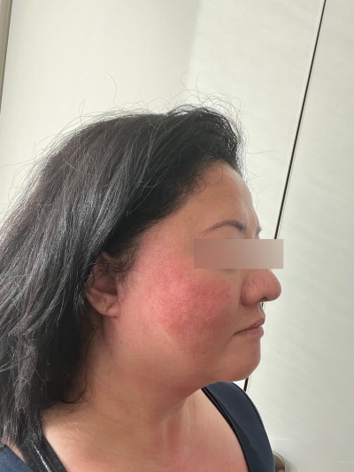 What to Know Before a Facelift Recovery Consultation: Recovery Period and Aftercare 사진 8