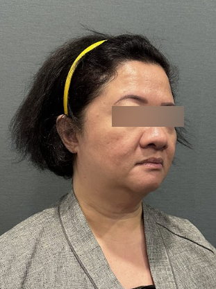 What to Know Before a Facelift Recovery Consultation: Recovery Period and Aftercare 사진 7