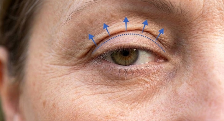 Changes Caused by Neglecting Eyelid Ptosis in Your 60s: Can Upper and Lower Blepharoplasty Help? 사진 3