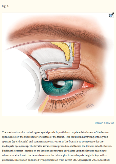 Changes Caused by Neglecting Eyelid Ptosis in Your 60s: Can Upper and Lower Blepharoplasty Help? 사진 6