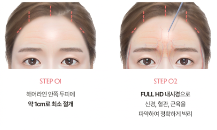 Endoscopic Forehead Lift Review: When Do Post-Surgery Changes Appear? Differences from Incision Methods 사진 3