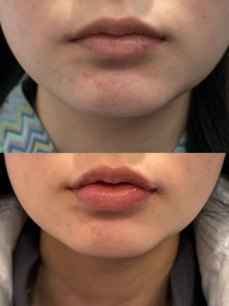 Menghilangkan Garis Senyum: Botox vs Filler vs Thread Lift vs RF Lifting, Panduan Pilihan 사진 5