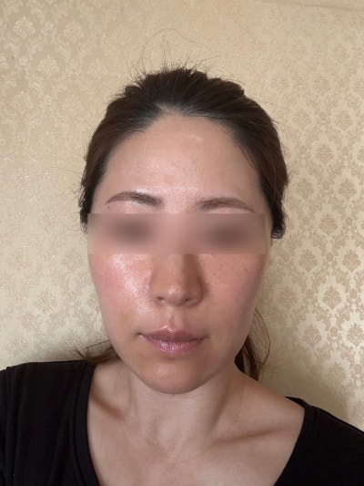 Menghilangkan Garis Senyum: Botox vs Filler vs Thread Lift vs RF Lifting, Panduan Pilihan 사진 10