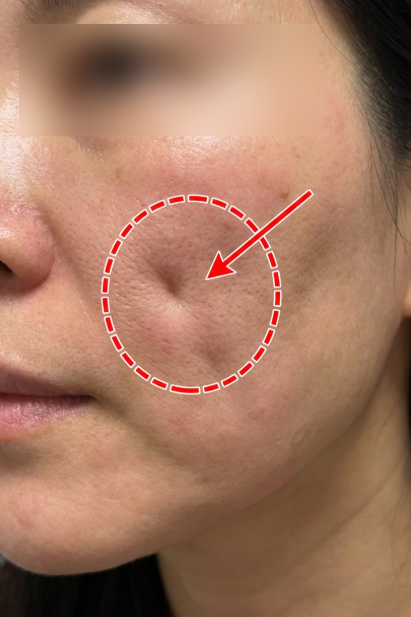 Mint Thread Lift 12 Lines, Ada Kriteria Desain Tersendiri yang Membuat Perbedaan Hasil 사진 12