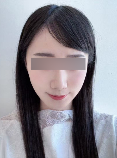 Malar Thread Lift: Understanding the Structure That Makes Cheekbones Appear Larger 사진 9