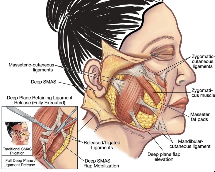 Tempat Terbaik untuk Midface Lift, Menjelaskan Alasan Perbedaan Hasil Antar Klinik 사진 3