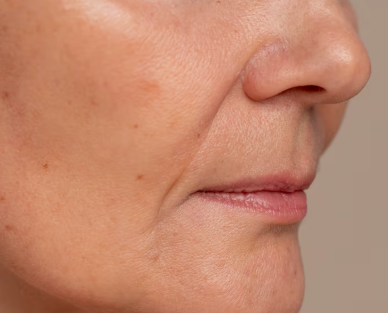 Thread Lift untuk Usia 50-an dan 60-an, Mengapa Garis Senyum dan Garis Rahang Harus Dilihat Bersamaan 사진 5