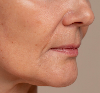 Deep Cheek Sagging Thread Lift: Most Reasons for Shortened Duration Start Here 사진 7