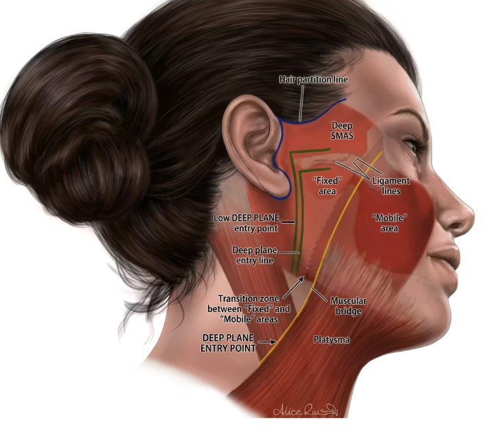 Satu Artikel Ini Lebih Baik dari 100 Ulasan Ponytail Lifting – Biaya, Bekas Luka, Sebelum & Sesudah 사진 9