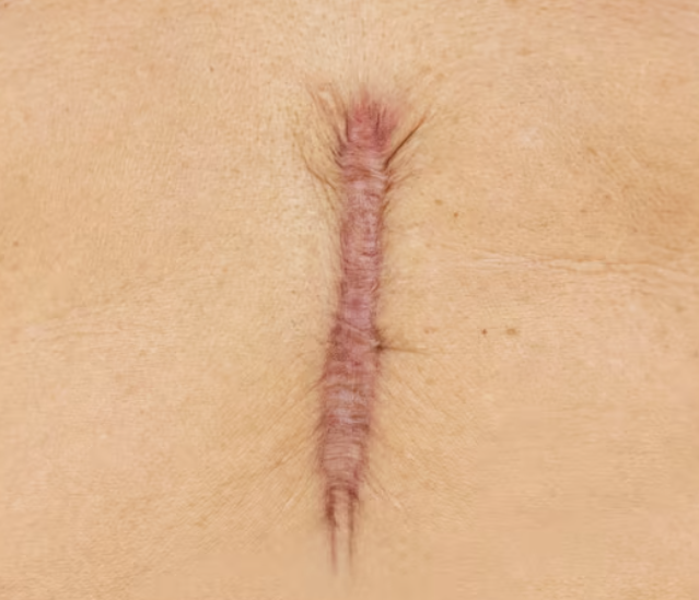 If you're worried about scars from forehead reduction surgery, check your hairline and recovery first. 사진 8