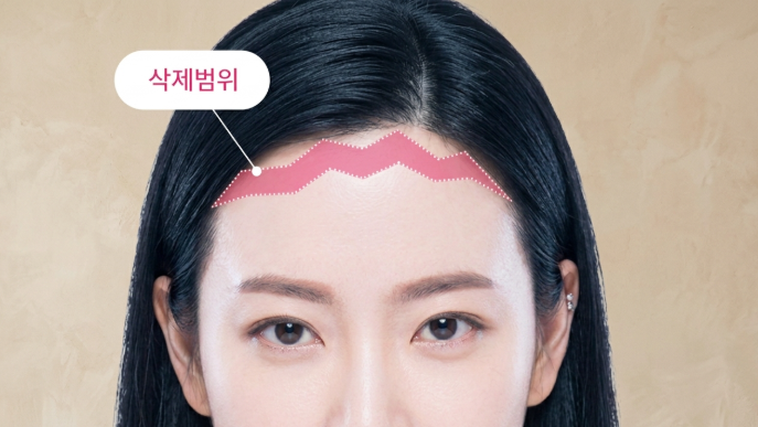 Why Karina's Forehead Lift Look Feels Different: Explaining Ptosis Improvement and Eye Shape Change