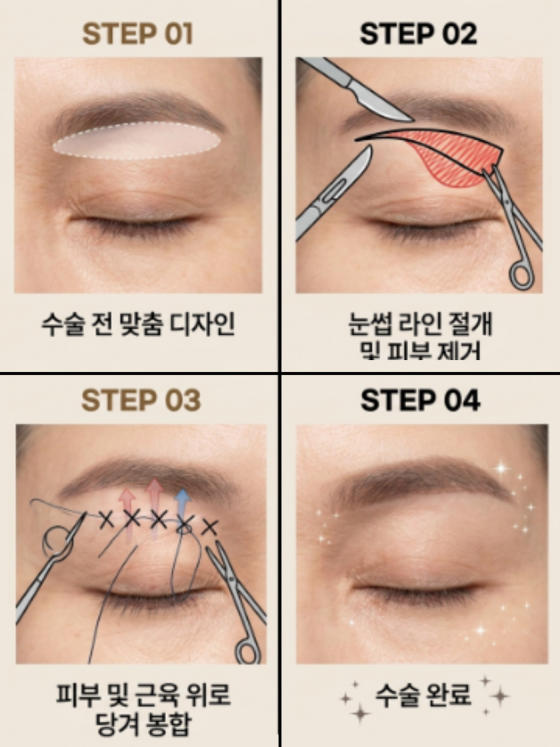 How Long Does Eyebrow Lift Recovery Take? Suture Removal & Swelling Changes by Stage 사진 7