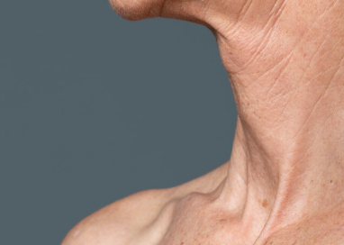 If you're nervous about male facelift reviews, let's explain based on actual cases 사진 4