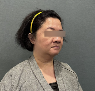 Gangnam Facelift Specialist: Explaining SMAS Layer Dissection and Lifting Range 사진 8