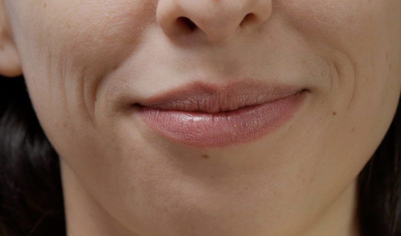 Alasan Mengapa Durasi Efek Thread Lift Garis Senyum Pendek, Ternyata Karena Hal Ini 사진 6