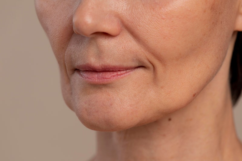 Alasan Mengapa Durasi Efek Thread Lift Garis Senyum Pendek, Ternyata Karena Hal Ini 사진 2