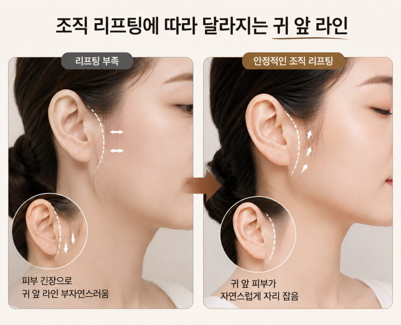 Kunci untuk menyembunyikan bekas luka mini-facelift secara alami adalah ‘arah tarikan’ 사진 8