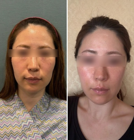 法令紋拉提，如果只打填充物覺得不夠，為什麼需要埋線拉提？ 사진 9