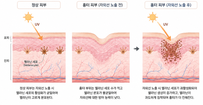 안면거상 흉터, 시간이 지나도 남는 사람과 옅어지는 사람의 차이 사진 6