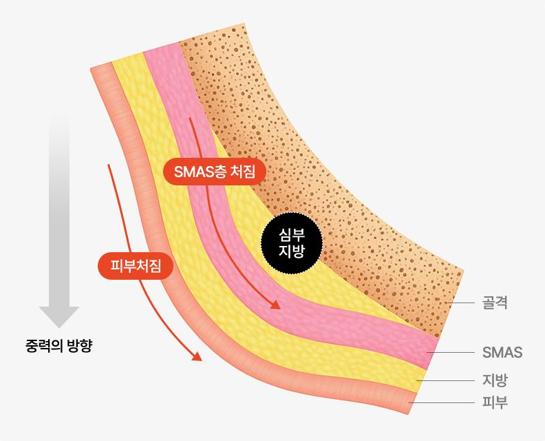 Mini Facelift Longevity: Differences Between Those Who Maintain Results Longer and Shorter 사진 4
