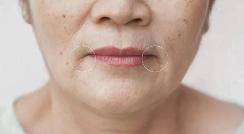 마리오네트주름시술, 주름만 채우면 해결되지 않는 이유 사진 6