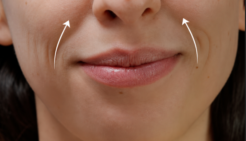 Nasolabial Fold Thread Lift: Results May Vary with the Severity of Nasolabial Folds 사진 5
