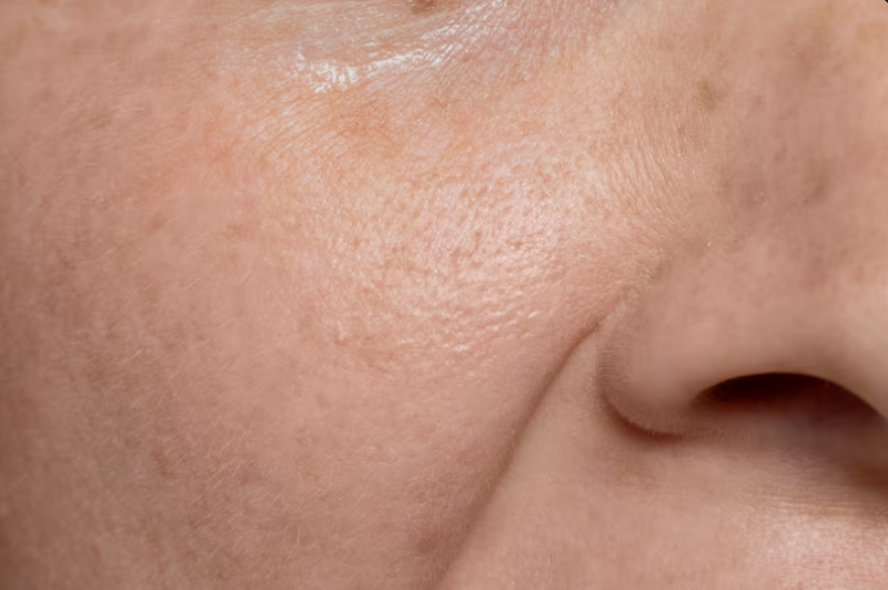 Nasolabial Fold Thread Lift: Results May Vary with the Severity of Nasolabial Folds 사진 3