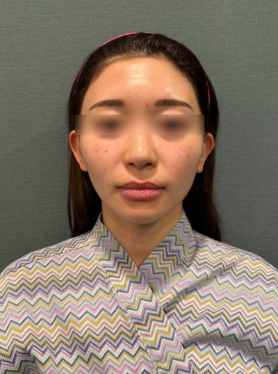 Mint Thread vs. Silhouette Soft vs. Cavaran Thread: What's the Difference in Lifting Effects? 사진 5