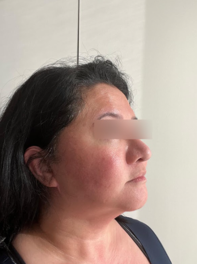 신논현역성형외과 무조건 많이 당긴다고 좋은 안면거상이 아닌 이유 사진 7