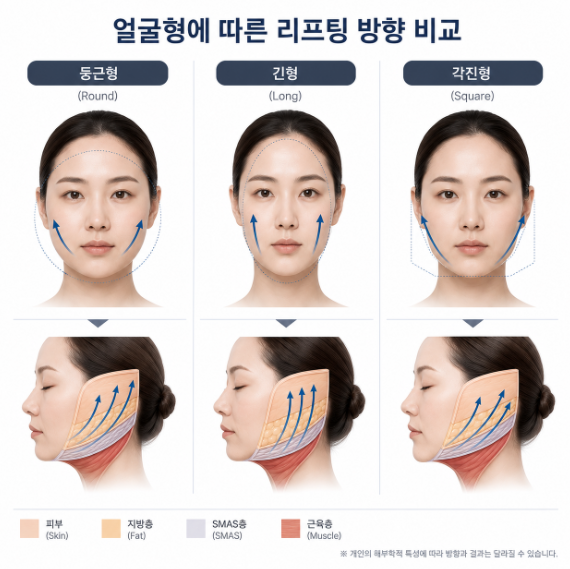 신논현역성형외과 무조건 많이 당긴다고 좋은 안면거상이 아닌 이유 사진 9