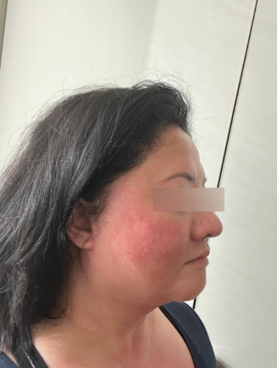 신논현역성형외과 무조건 많이 당긴다고 좋은 안면거상이 아닌 이유 사진 6