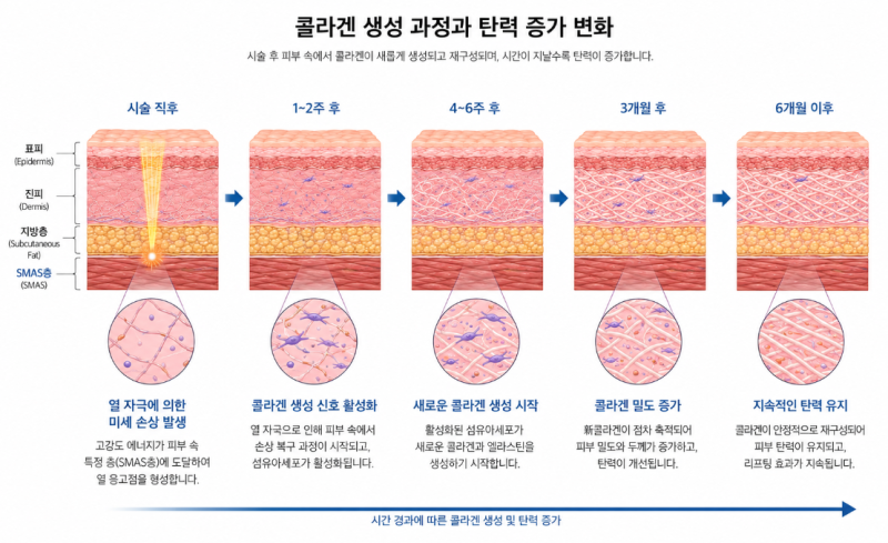압토스 울쎄라 비교, 리프팅 효과를 결정하는 핵심 포인트 사진 6