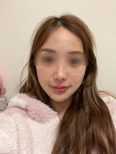 강남 실리프팅 후기, 전후 사진으로 확인한 변화는? 사진 11