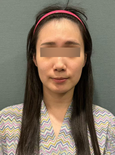 압토스실리프팅, 선택 전 헷갈리는 부분 정리 사진 5