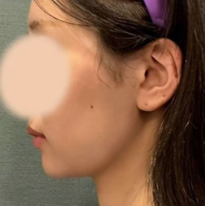 압토스실리프팅, 선택 전 헷갈리는 부분 정리 사진 8