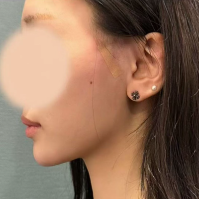 압토스실리프팅, 선택 전 헷갈리는 부분 정리 사진 9