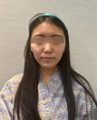 압토스, 민트실, 실루엣소프트 비교, 실리프팅 선택 기준은? 사진 9