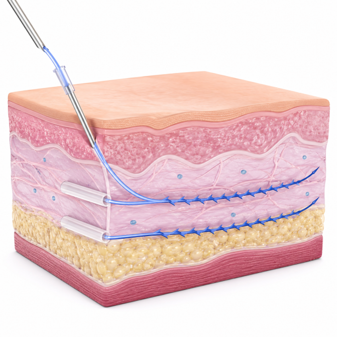 Where to Get a Good Thread Lift in Seoul: 3 Criteria for Satisfactory Results 사진 3