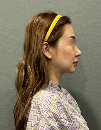 Where to Get a Good Thread Lift in Seoul: 3 Criteria for Satisfactory Results 사진 7