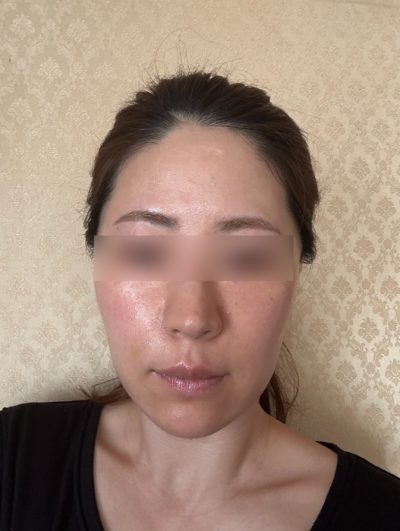 서울 실리프팅 추천, 만족도를 높이는 선택 기준은 따로 있습니다 사진 11