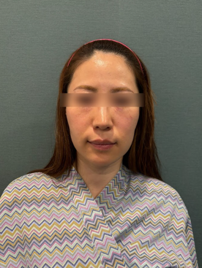 서울 실리프팅 추천, 만족도를 높이는 선택 기준은 따로 있습니다 사진 10