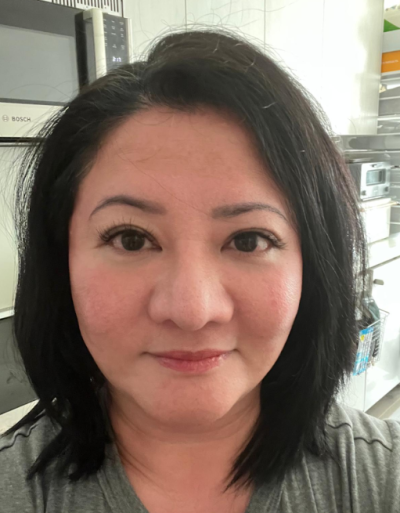 안면거상, 팔자주름 개선은 '당기는 방향'이 중요합니다 사진 9