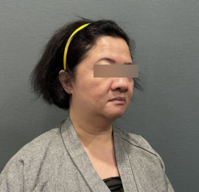 안면거상, 팔자주름 개선은 '당기는 방향'이 중요합니다 사진 8