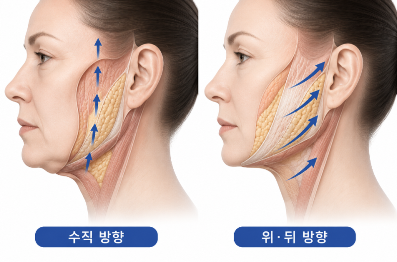 강남안면거상잘하는병원, 턱선이 살아나는 리프팅의 차이 사진 5