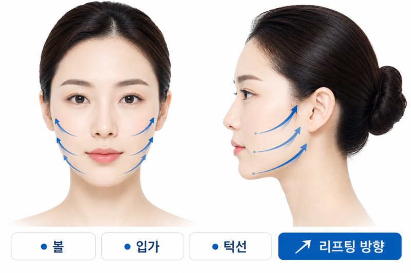 강남안면거상잘하는병원, 턱선이 살아나는 리프팅의 차이 사진 6