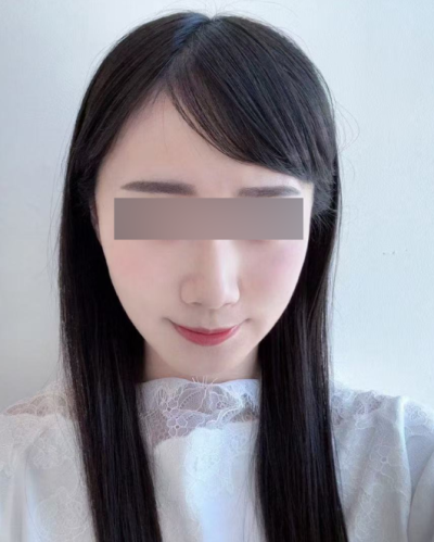 민트실리프팅 부작용, 딤플·처짐이 생기는 이유와 회복 과정 사진 9