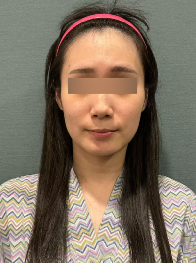 민트실리프팅 부작용, 딤플·처짐이 생기는 이유와 회복 과정 사진 8