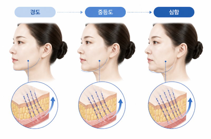 민트실리프팅 부작용, 딤플·처짐이 생기는 이유와 회복 과정
